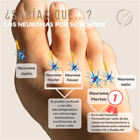 Los Neuromas Por Su Nombre Dr Carrillo Pi Ero