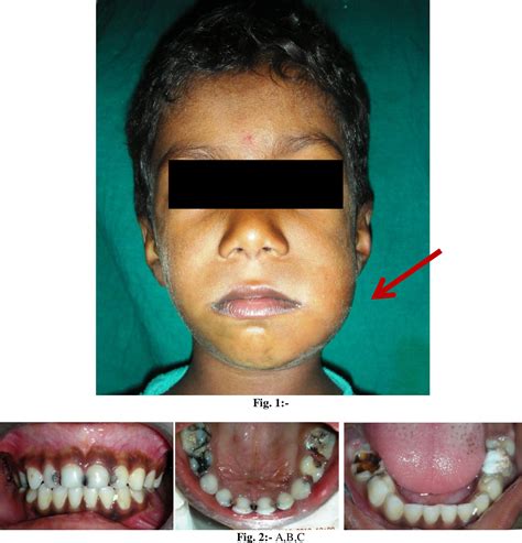 Figure 2 From Anatomical And Physiological Considerartions In Management Of Odontogenic