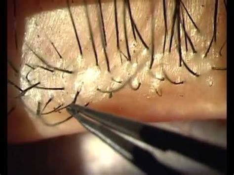 demodex folliculorum - pictures, photos