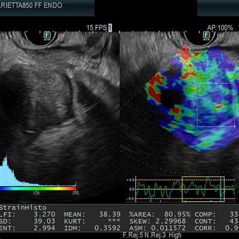 Endoscopic Ultrasound Guided Strain Elastography Of A Solid Pancreatic