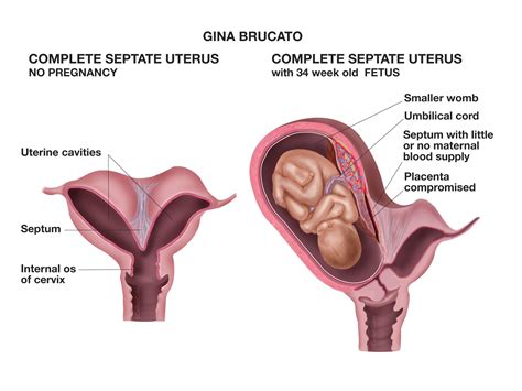 Didelphys Uterus Ultrasound