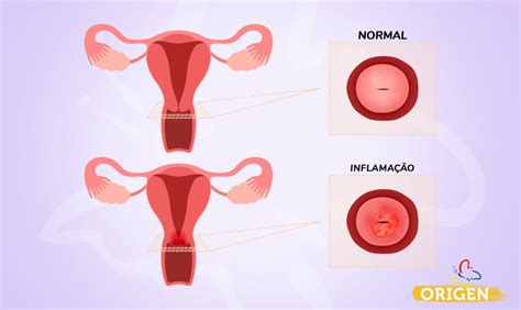 Colo do útero qual sua função na fertilidade