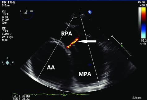 Upper Esophageal Ascending Aorta Short Axis View On Transesophageal