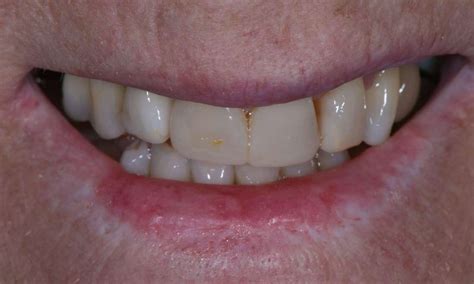 10 Upper Porcelain Crowns Results Brisbane Dentist