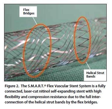 Endovascular Today The S M A R T Flex Vascular Stent System