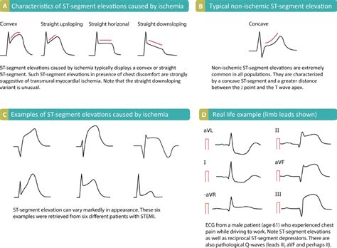 ST segment elevation in acute myocardial ischemia and differential ...