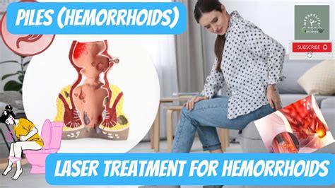 Piles Hemorrhoids And Laser Treatment For Hemorrhoids Laser