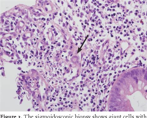 Figure 3 From A Case Of Hemophagocytic Syndrome In A Patient With