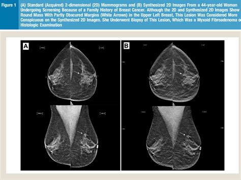 Figure 1 From Evidence On Synthesized Twodimensional Mammography