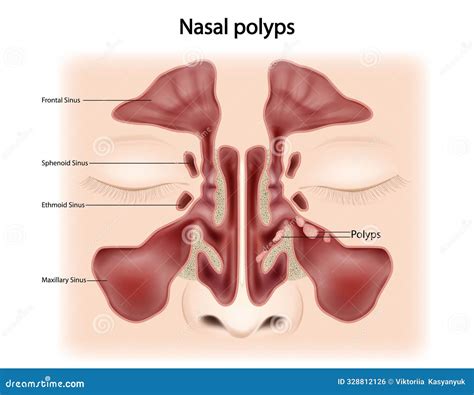 Nasal Polyps Medical Illustration On White Background Cartoon Vector