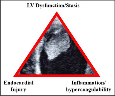 Figure 1 From Management Of Patients At Risk For And With Left Ventricular Thrombus A