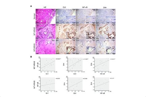 Gli1 NF KB P65 And Shh Protein Expression In PDAC Tissues With Or