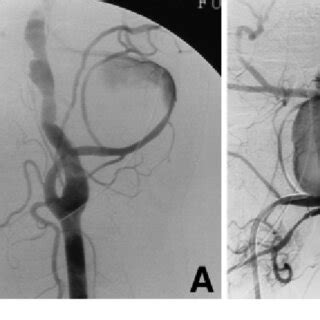 Left Vertebral Angiograms Anteroposterior View A Days After