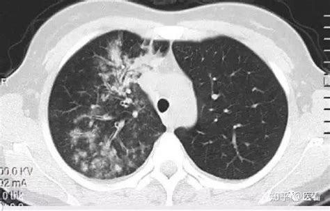 霸气总结！一句话看懂17种肺部感染的医学影像诊断！ 知乎