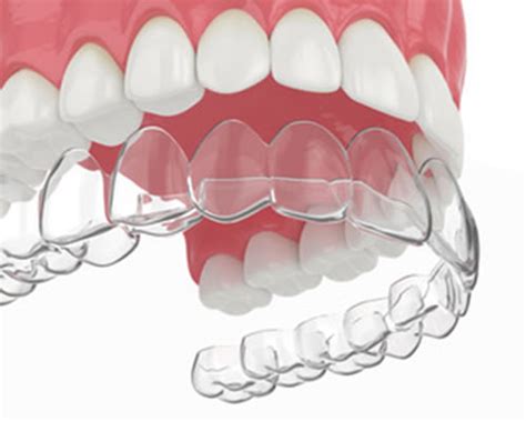 Invisalign Clear Aligners Lansdowne Dental