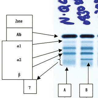 Patient S Serum Protein Immunofixation Electrophoresis Serum Protein