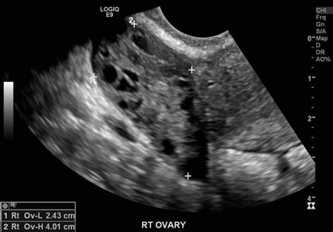 Ultrasound Ovarian Torsion BROWN EMERGENCY MEDICINE