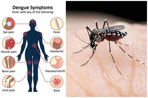 Dengue In Italia Nuovi Casi Segnalati A Roma