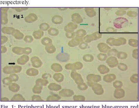 A Study Of Rapid Leishman Stain On Peripheral Blood Smear Semantic