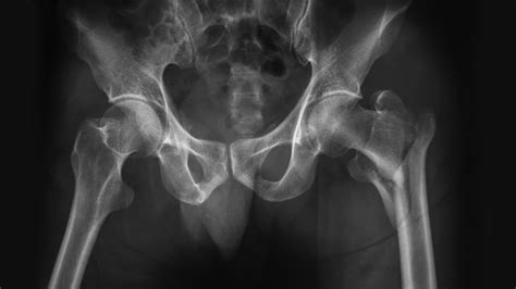 Fracture De Hanche Types De Fractures Et Traitements CPHG Paris