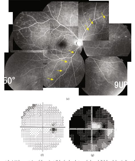 Figure 1 From Retinal Pigment Epithelial Tears After Ex PRESS