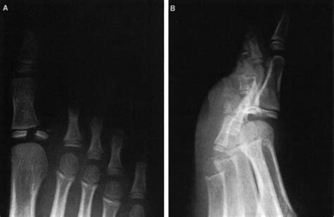 Salter Harris Type IV Epiphyseal Fracture Of The Proximal Phalanx Of