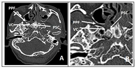 (A&B) Axial CT examinations. It showed relationship of foramen ...