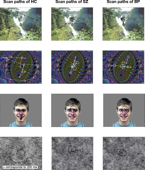 Recent Updates Of Eye Movement Abnormalities In Patients With