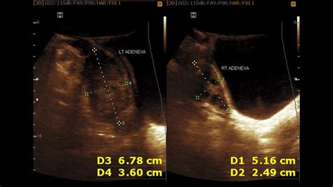 Dermoid Cyst Youtube