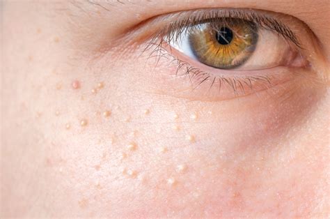 Those tiny white bumps on your face aren t acne – Artofit