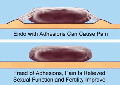 Pelvic Therapy for Endometriosis, Adhesions and Sexual Pain- Hormones Matter