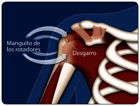 Opciones Para Tratar El Desgarro De Los Músculos Y Tendones Del Hombro