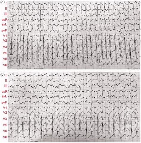 Electrocardiogram Showing Atrial Fibrillation With Aberrant Conduction