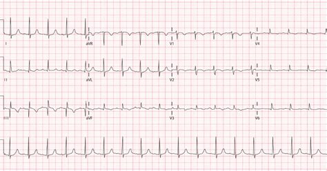 Recognising Myocardial Infarction Patterns On The Ecg Medical Exam Prep