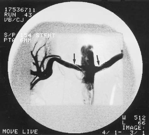 Figure 1 From Flash Pulmonary Edema Heralding Renal Artery Stenosis Semantic Scholar