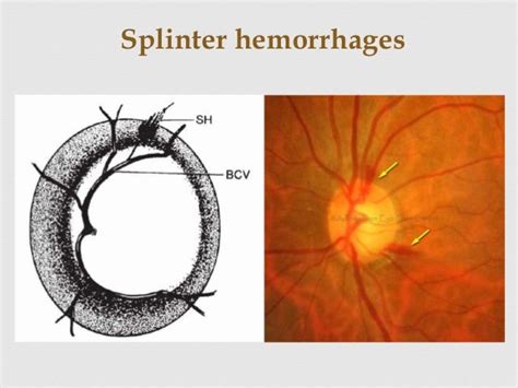 Optic nerve head evaluation in glaucoma