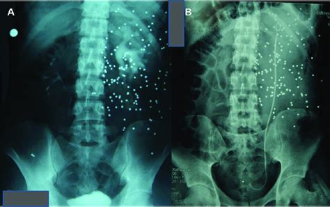 A Intravenous Pyelogram Demonstrates Calyectasis Dilatation Of