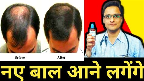 Hair Fall Solution नए बाल उगाने का गारंटेड नुस्ख़ा।बाल झड़ना बंद Hair