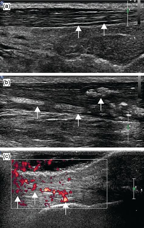 Ultrasound Characteristics Of The Achilles Tendon In Tophaceous Gout A Comparison With Age And