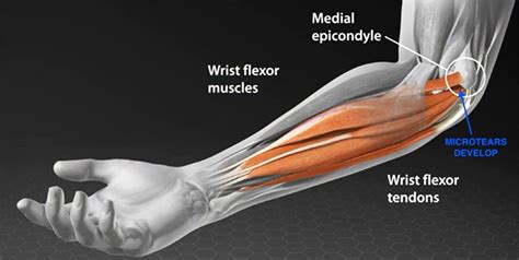 Golfers Elbow