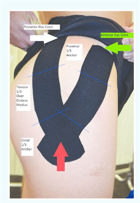 Kinesio Tape Of The Affected Limb Hip For Facilitation Of Gluteus