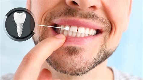 Cu Ntos Implantes Dentales Se Pueden Poner En Un D A Clinica Dental