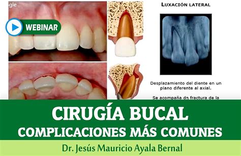 WEBINAR Complicaciones en Cirugía Bucal Dr Jesús Mauricio Ayala Bernal