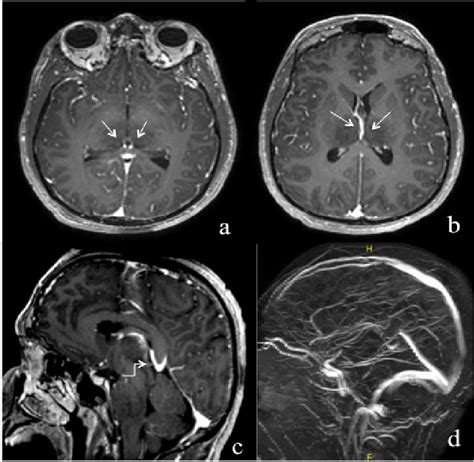 Magnetic Resonance Venography Mrv Of The Brain Showing Patent