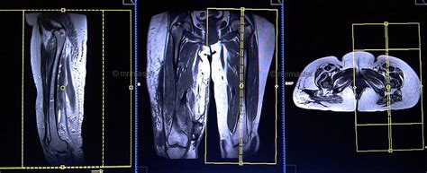 Mri Thigh Upper Legs Planning Mri Hamstring Protocols Indications