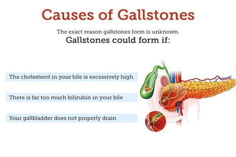 Causes Of Cholelithiasis Medizzy