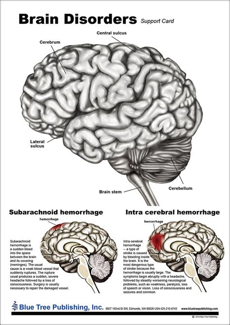 Brain Disorders Anatomical Chart - Etsy