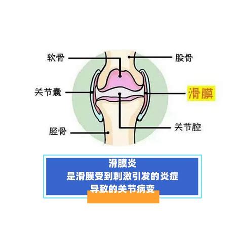 滑膜炎导致的关节积液，膝盖疼痛怎么缓解，如何恢复？ 知乎