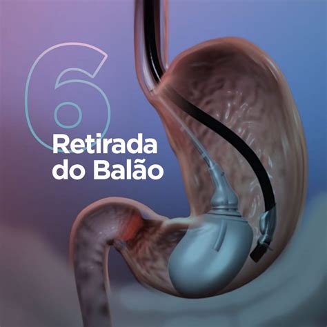 Balão Intragástrico saiba onde você pode colocar o Balão Spatz 3