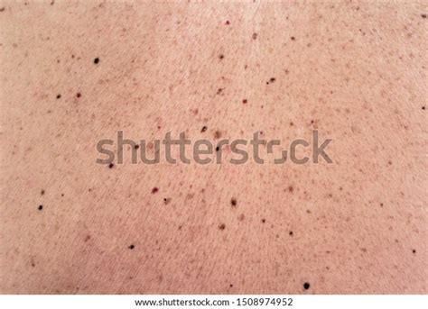 Skin Texture Black Birthmarks Moles On Stock Photo 1508974952